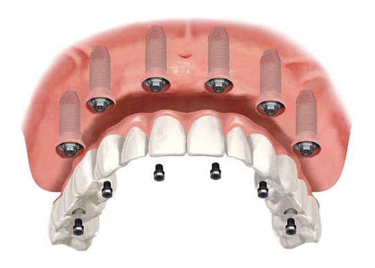 Impianti dentali all on six roma studio kol